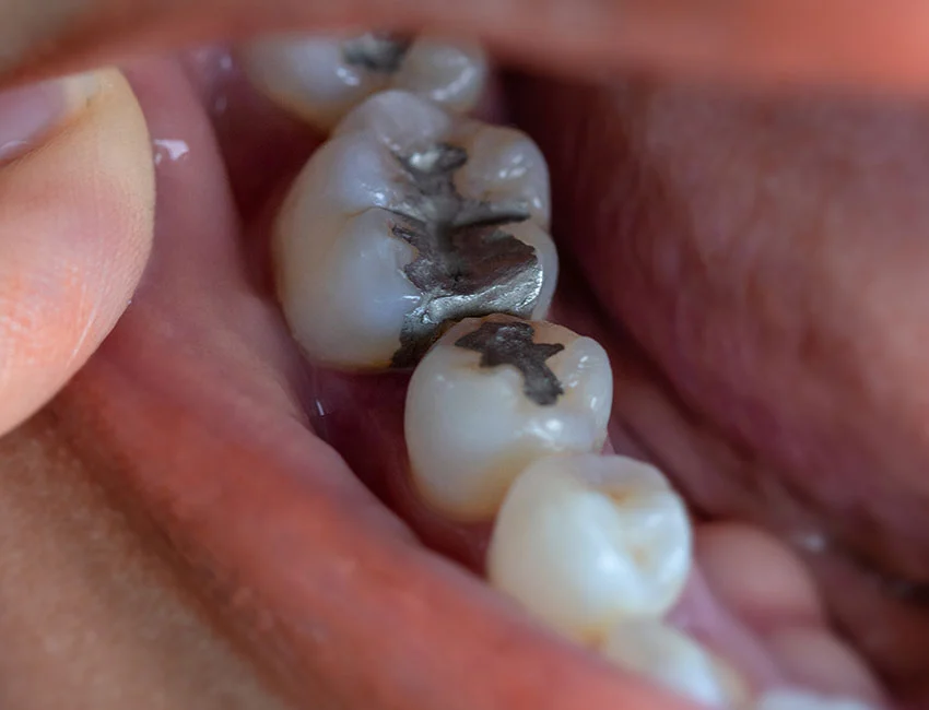 Amalgam silver dental fillings