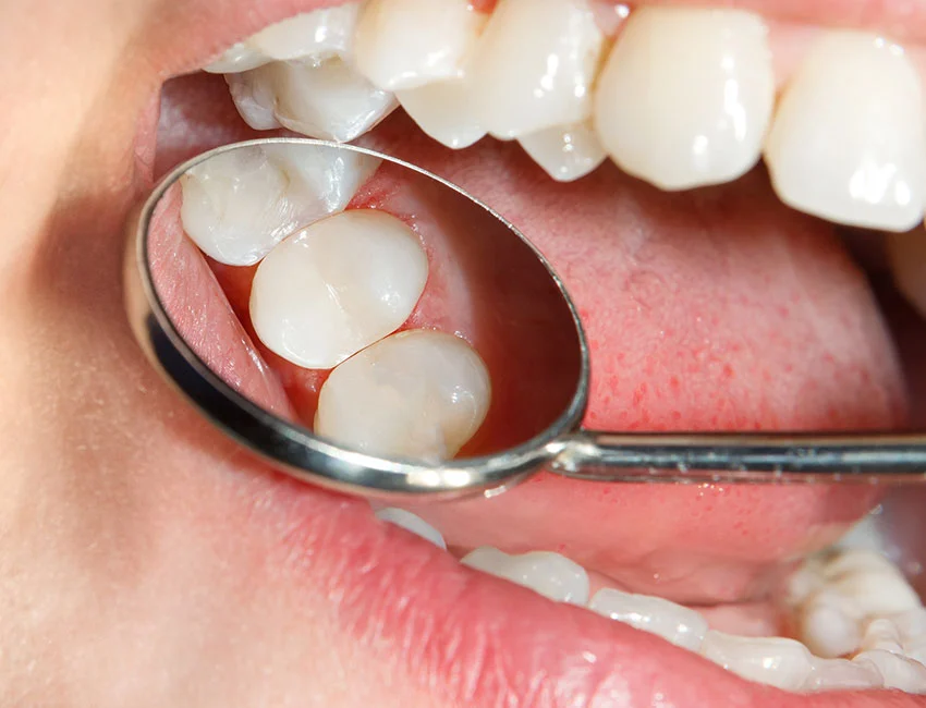 Composite white dental fillings
