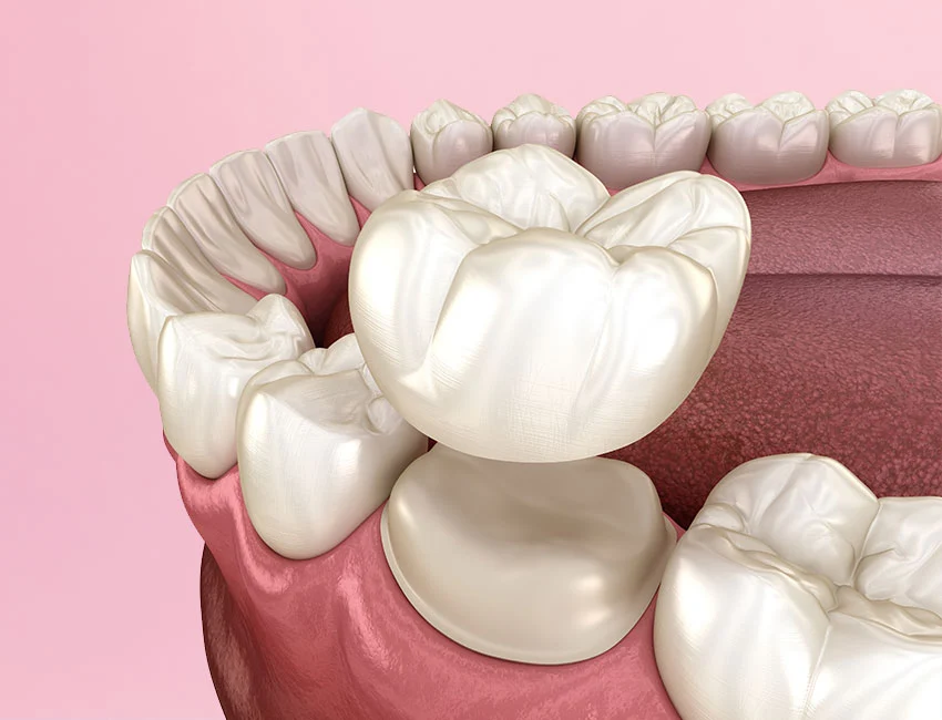 Dental crown in 3D model