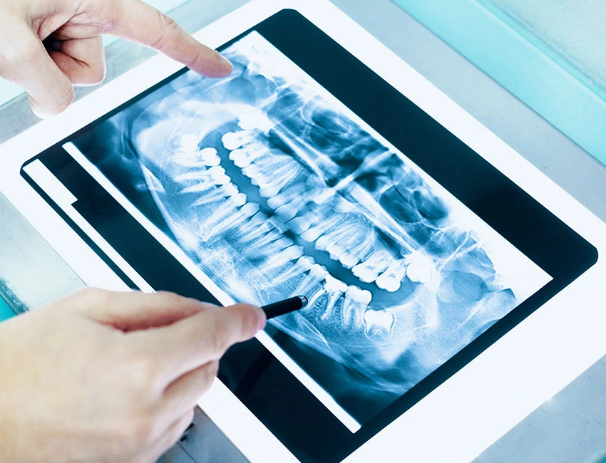 Dental digital X-ray