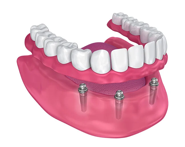 Implant supported dentures - Overdentures