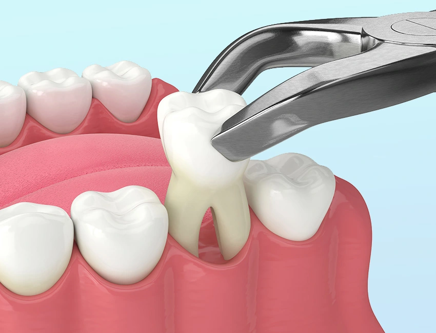 Tooth extraction 3D