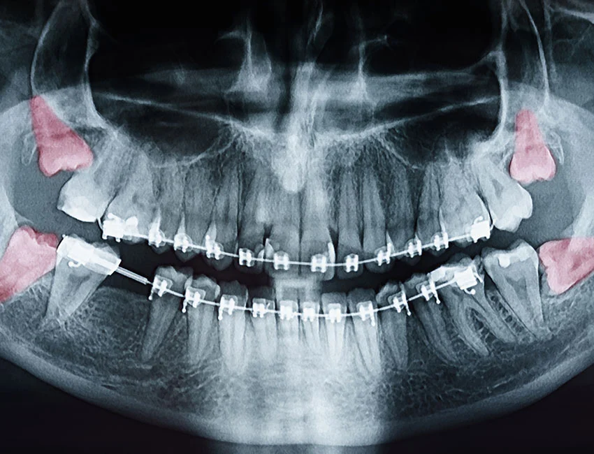 Dental x-ray showing impacted wisdom teeth